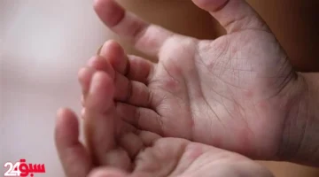مرض اليد والقدم والفم يظهر بمدارس المريوطية.. نصائح عاجلة لحماية طفلك